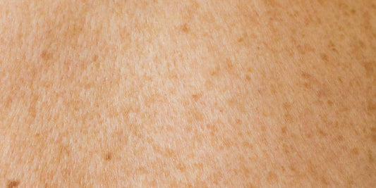 Manchas na Pele: Entenda as Causas, Tipos e Melhores Tratamentos - Bello Sconto